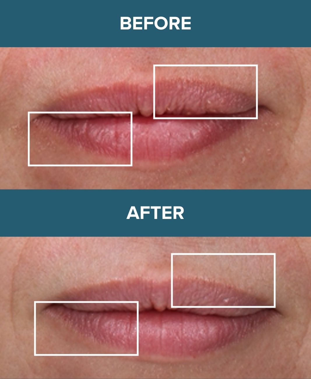 Before and after comparison of lips using LipBoost with visible improvement.
